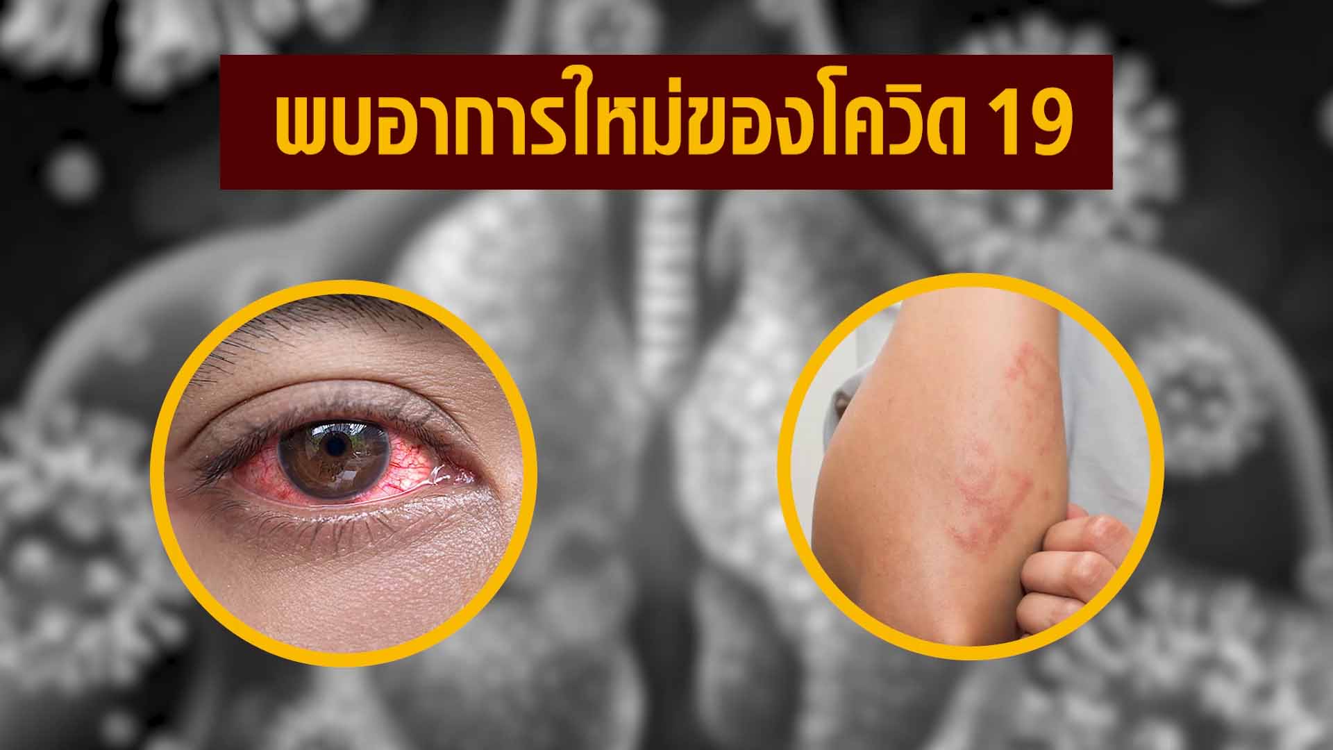 พบอาการใหม่โควิด-19 ทีมแพทย์จีนเหลียนฮัว ฮั่วเซียง เอินเวย์ Enwei แนะแนวทางป้องกันรักษา